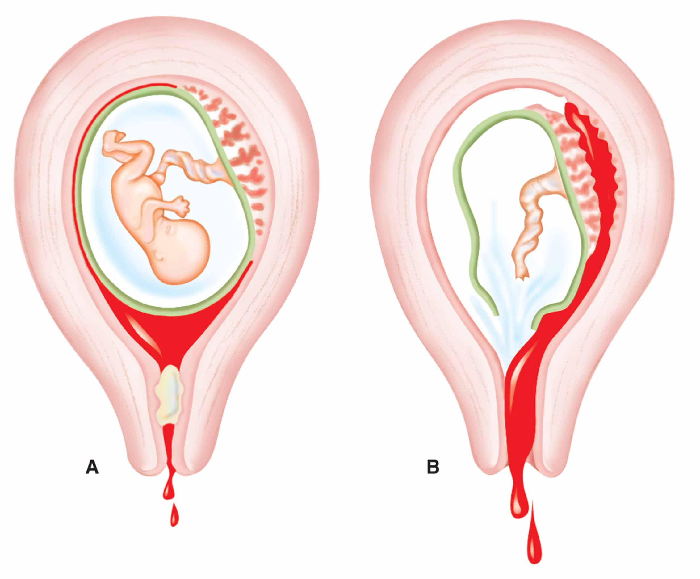 Read more about the article What is an incomplete abortion.