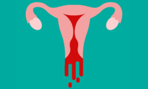 Read more about the article Bleeding