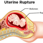 Abortions and Uterine Rupture. 