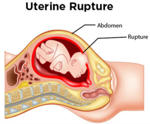 Read more about the article Abortions and Uterine Rupture. 