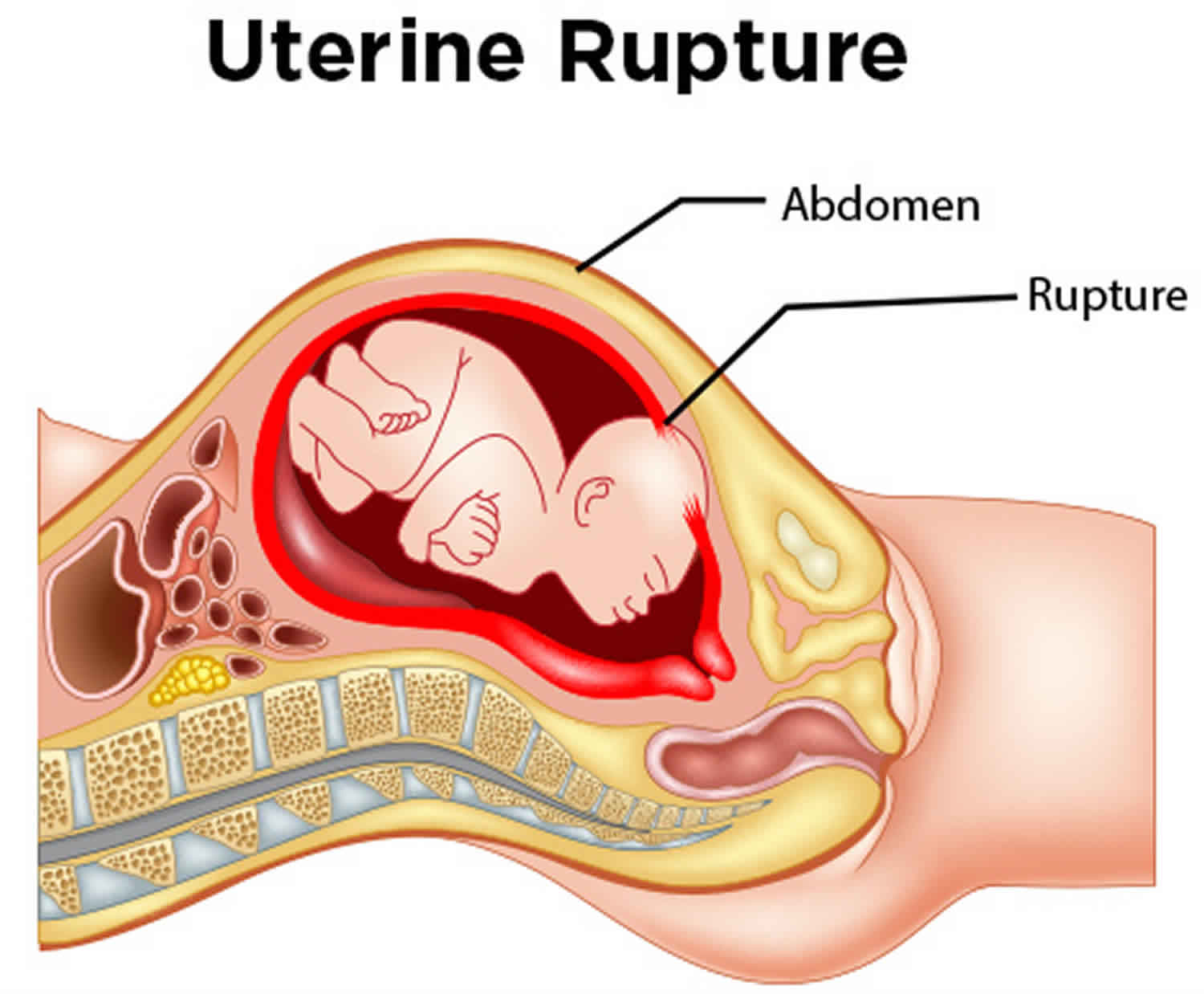 Read more about the article Abortions and Uterine Rupture. 