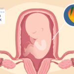How to Safely Terminate a 19-Week Pregnancy