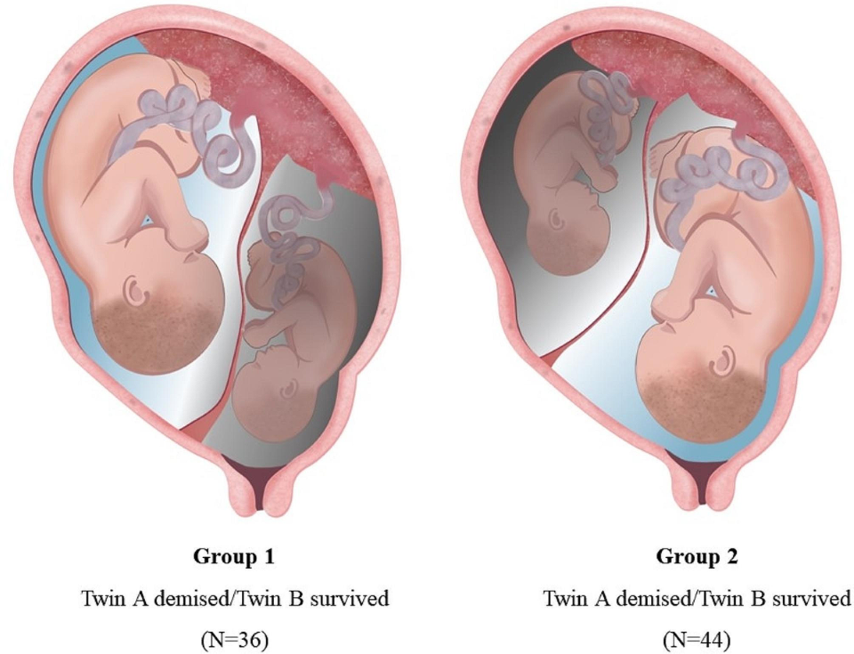 Read more about the article 🩺 Abortion in Early Pregnancy and Twin Pregnancy