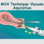 How MVA (Manual Vacuum Aspiration) Is Done