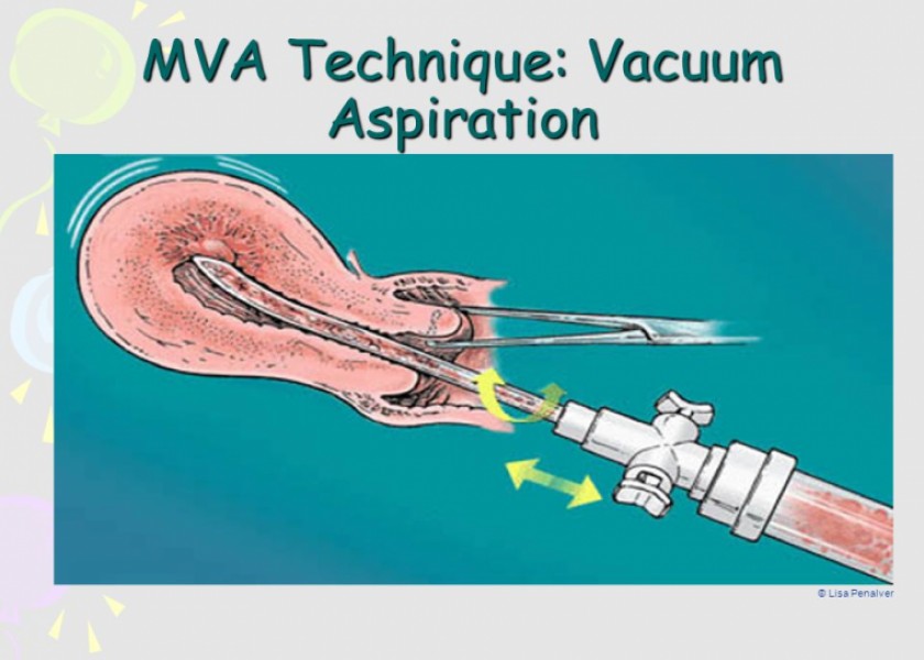Read more about the article How MVA (Manual Vacuum Aspiration) Is Done