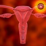 Ectopic Pregnancy: Signs, Symptoms, Types, and Management